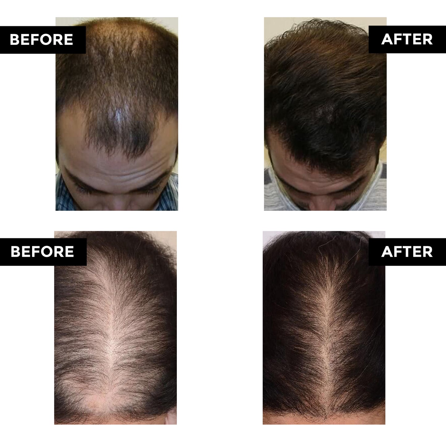 Advance Hair Growth Serum(Pack Of 2)