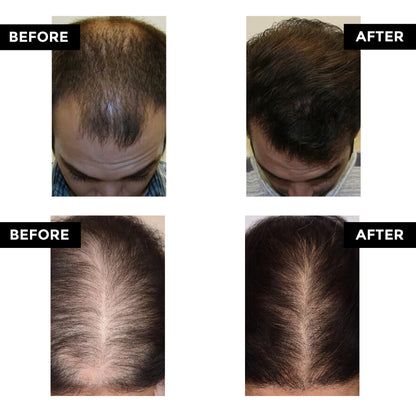 Advance Hair Growth Serum(Pack Of 2)